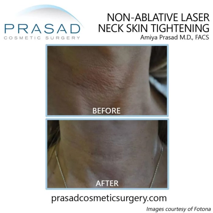 Tighten Loose Neck Skin